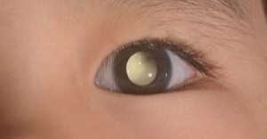 A Blink That Saved a Life: How One Educator Detected Retinoblastoma in a Toddler