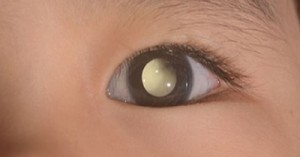 A Blink That Saved a Life: How One Educator Detected Retinoblastoma in a Toddler