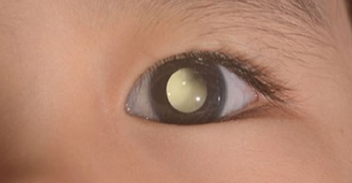A Blink That Saved a Life: How One Educator Detected Retinoblastoma in a Toddler