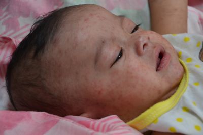 Measles Outbreak Alert and Measles Symptoms