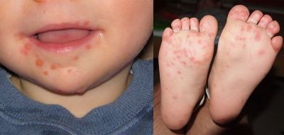 Information on Hand Foot and Mouth disease