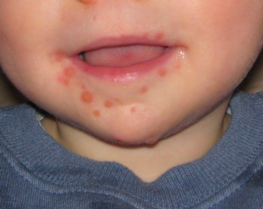 Hand Foot and Mouth Disease is Spreading