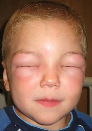 Common Food Allergies In Children