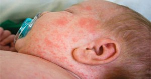 Baby Contracts Measles In Sydney - Warning of Outbreak Issued