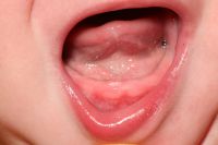 Teething