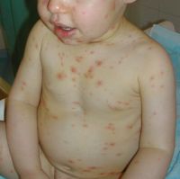 Chickenpox