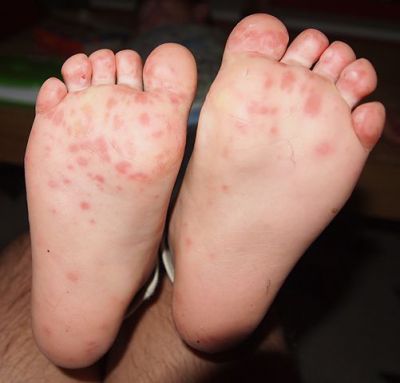 Hand Foot and Mouth Disease