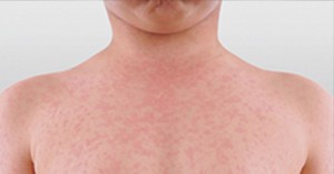 Measles Alert For Brisbane