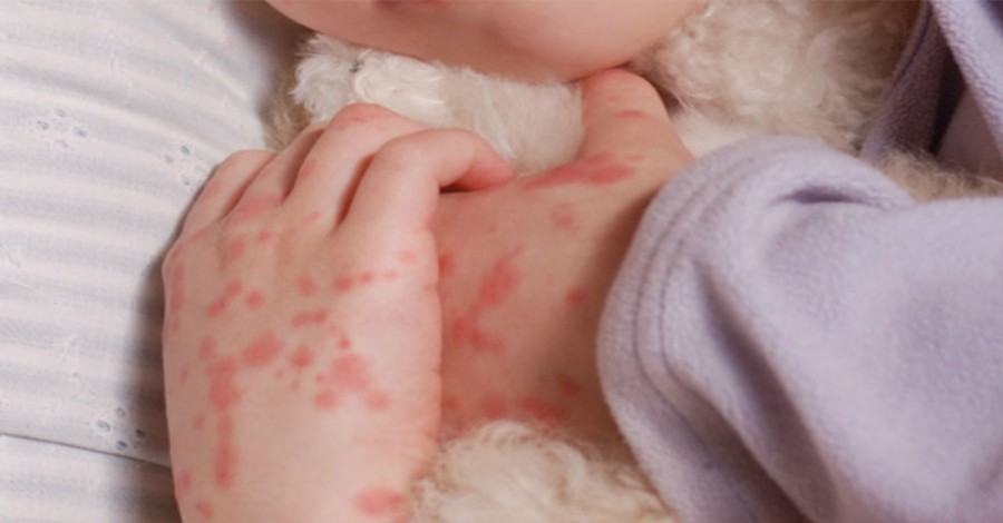 Toddler Contracts Meningococcal Disease in South Australia